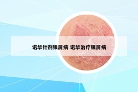 诺华针剂银屑病 诺华治疗银屑病