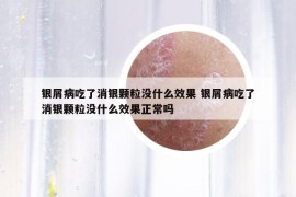 银屑病吃了消银颗粒没什么效果 银屑病吃了消银颗粒没什么效果正常吗