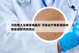 河南哪儿治银屑病最好 河南治疗银屑病郑州银屑病研究院地址