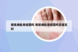 银屑病能用硅霜吗 银屑病能用硅霜吗百度百科
