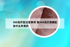 308光疗后注意事项 做308光疗需要配合什么外用药