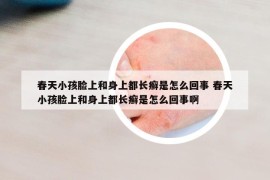 春天小孩脸上和身上都长癣是怎么回事 春天小孩脸上和身上都长癣是怎么回事啊