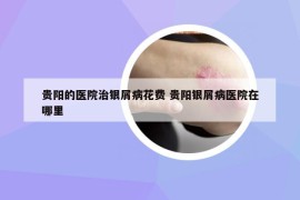 贵阳的医院治银屑病花费 贵阳银屑病医院在哪里