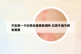 只出现一个红斑会是银屑病吗 红斑不痛不痒有银屑