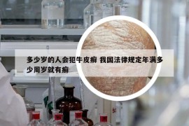 多少岁的人会犯牛皮癣 我国法律规定年满多少周岁就有癣