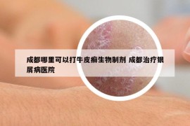 成都哪里可以打牛皮癣生物制剂 成都治疗银屑病医院