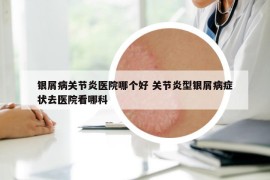 银屑病关节炎医院哪个好 关节炎型银屑病症状去医院看哪科