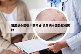 银屑病全国哪个医院好 银屑病全国最权威医院