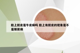 脸上脱皮是牛皮癣吗 脸上有脱皮的现象是不是银屑病