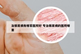 治银屑病有哪家医院好 专治银屑病的医院哪里