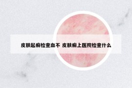 皮肤起癣检查血不 皮肤癣上医院检查什么