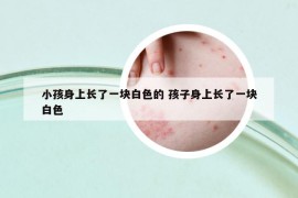 小孩身上长了一块白色的 孩子身上长了一块白色