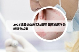 2023银屑病临床实验招募 银屑病医学最新研究成果
