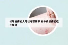 长牛皮癣的人可以吃芒果不 有牛皮病癣能吃芒果吗