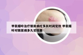 甲氨蝶呤治疗银屑病吃多长时间见效 甲氨蝶呤对银屑病多久见效果