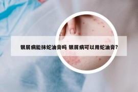 银屑病能抹蛇油膏吗 银屑病可以用蛇油膏?