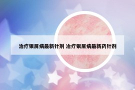 治疗银屑病最新针剂 冶疗银屑病最新药针剂