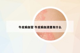 牛皮癣血管 牛皮癣血液里有什么