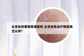 北京协和看银屑病贵吗 北京协和治疗银屑病怎么样?