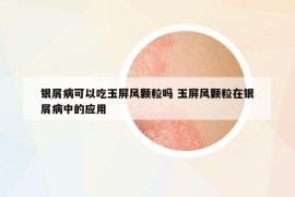 银屑病可以吃玉屏风颗粒吗 玉屏风颗粒在银屑病中的应用