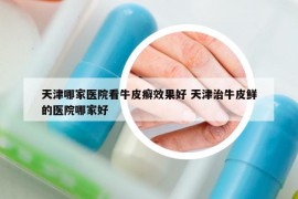 天津哪家医院看牛皮癣效果好 天津治牛皮鲜的医院哪家好