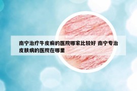 南宁治疗牛皮癣的医院哪家比较好 南宁专治皮肤病的医院在哪里