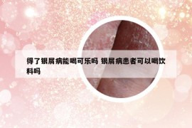 得了银屑病能喝可乐吗 银屑病患者可以喝饮料吗