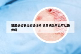 银屑病关节炎能锻炼吗 银屑病关节炎可以跑步吗