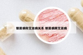 银屑病和艾滋病关系 银屑病跟艾滋病