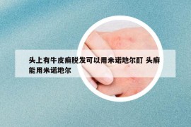 头上有牛皮癣脱发可以用米诺地尔酊 头癣 能用米诺地尔