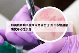 郑州银屑病研究所周文敬主任 郑州市银屑病研究中心怎么样