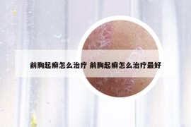 前胸起癣怎么治疗 前胸起癣怎么治疗最好