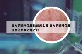 复方酮康唑发用洗剂怎么用 复方酮康唑发用洗剂怎么用效果才好