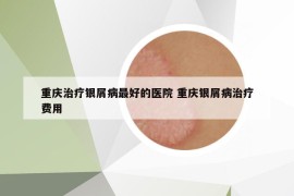 重庆治疗银屑病最好的医院 重庆银屑病治疗费用