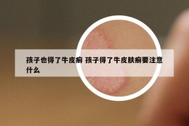 孩子也得了牛皮癣 孩子得了牛皮肤癣要注意什么