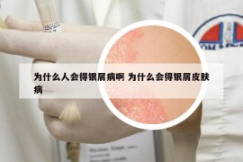 为什么人会得银屑病啊 为什么会得银屑皮肤病