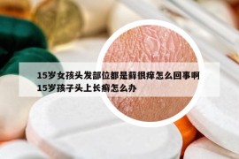 15岁女孩头发部位都是藓很痒怎么回事啊 15岁孩子头上长癣怎么办