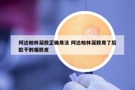 阿达帕林凝胶正确用法 阿达帕林凝胶用了后脸干刺痛脱皮