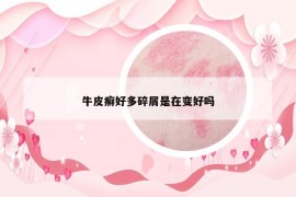 牛皮癣好多碎屑是在变好吗