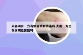 夫妻间有一方有银屑病会传染吗 夫妻一方患银屑病能离婚吗
