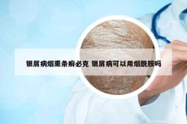 银屑病烟熏条癣必克 银屑病可以用烟酰胺吗