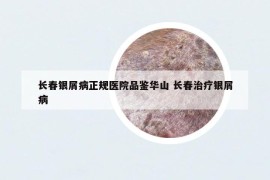 长春银屑病正规医院品鉴华山 长春治疗银屑病
