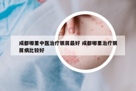 成都哪里中医治疗银屑最好 成都哪里治疗银屑病比较好