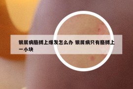 银屑病胳膊上爆发怎么办 银屑病只有胳膊上一小块