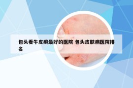 包头看牛皮癣最好的医院 包头皮肤病医院排名