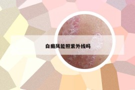 白癜风能照紫外线吗