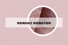 银屑病的秘方 银屑病秘方轻粉