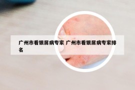 广州市看银屑病专家 广州市看银屑病专家排名