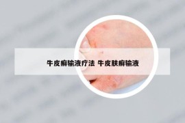 牛皮癣输液疗法 牛皮肤癣输液