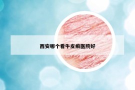 西安哪个看牛皮癣医院好